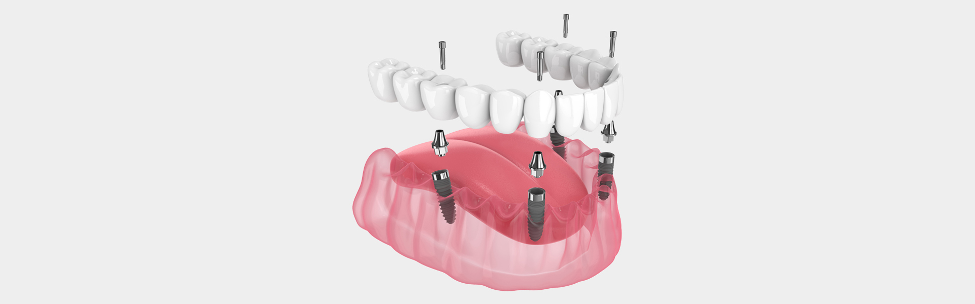 Decoding Dental Implants: Weighing the Ups and Downs of All 4 Options – Unveiling the Expert Insights from Tri-Cities Dental Specialists